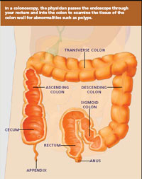 Understanding Colonoscopy Illustration