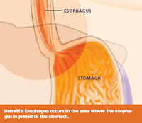 Barrett's Esophagus Illust. 1
