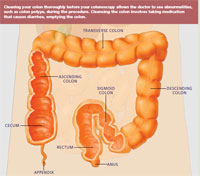 how to prep colonoscopy