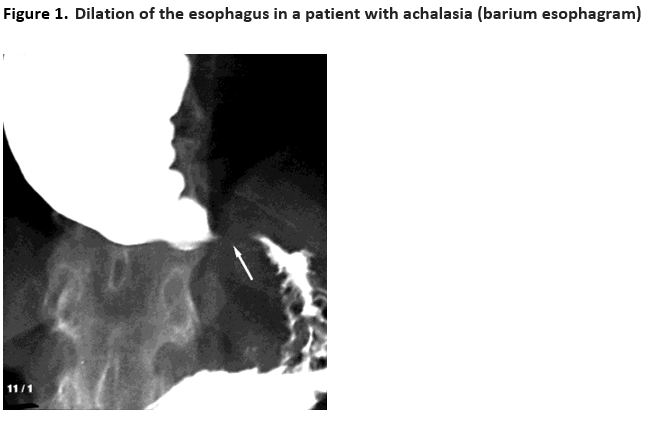 Figure 1. Dilation of the esophagus in a patient with achalasia (barium esophogram)