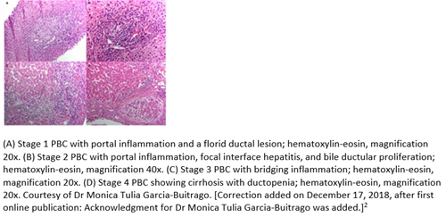 (A) Stage 1 with portal inflammation and a florid ductal lesion; hematoxylin-eosin, magnification 20x. (B) Stage 2 PBC with portal inflammation, focal interface hepatitis, and bile ductular proliferation; hematoxylin-eosin, magnification 40x. (C) Stage 3 PBC with bridging inflammation; hematoxylin-eosin, magnification 20x. (D) Stage 4 PBC showing cirrhosis with ductopenia; hematoxylin-eosin, magnification 20x. Courtesy of Dr. Monica Tulia Garcia-Buitrago. [Correction added on December 18, 2018, after first online publication: Acknowledgement for Dr. Monica Tulia Garcia-Buitrago was added.]