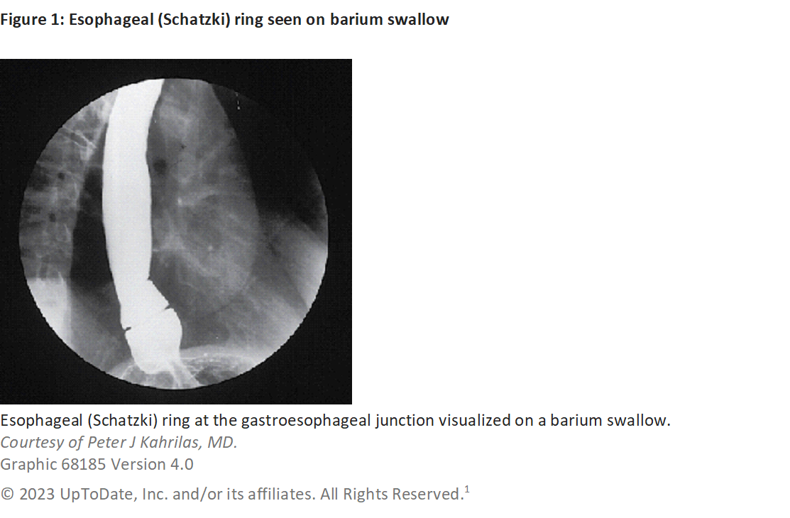 Schatzkin ring barium swallow