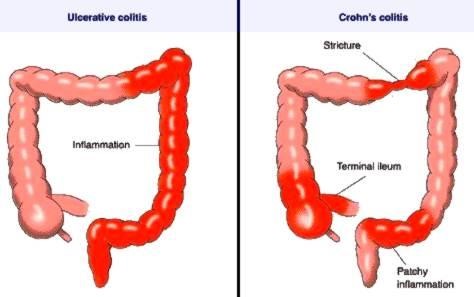 stricture stricture