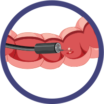 Colonoscopy detecting and removing polyps